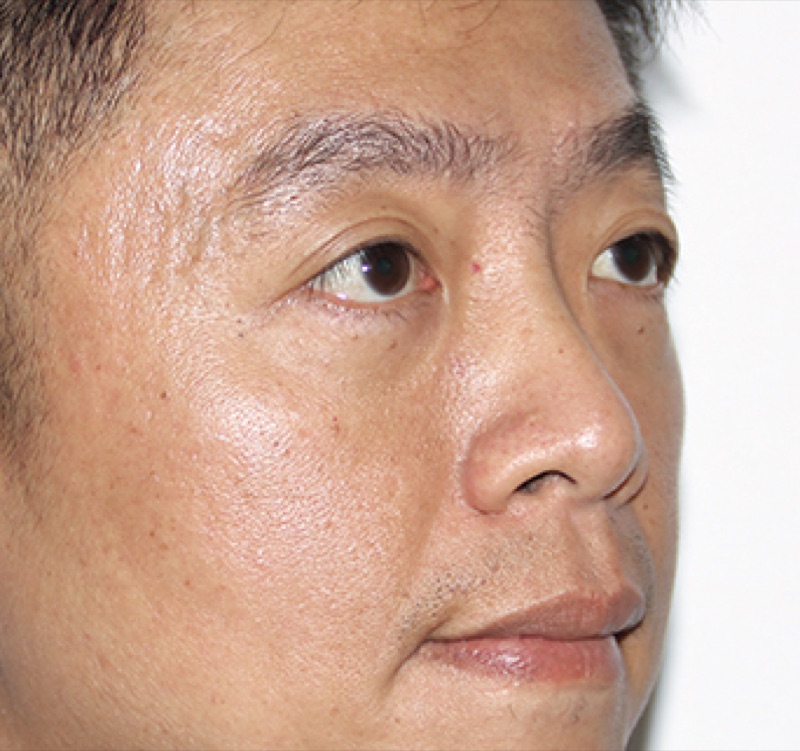 眼袋整復案例