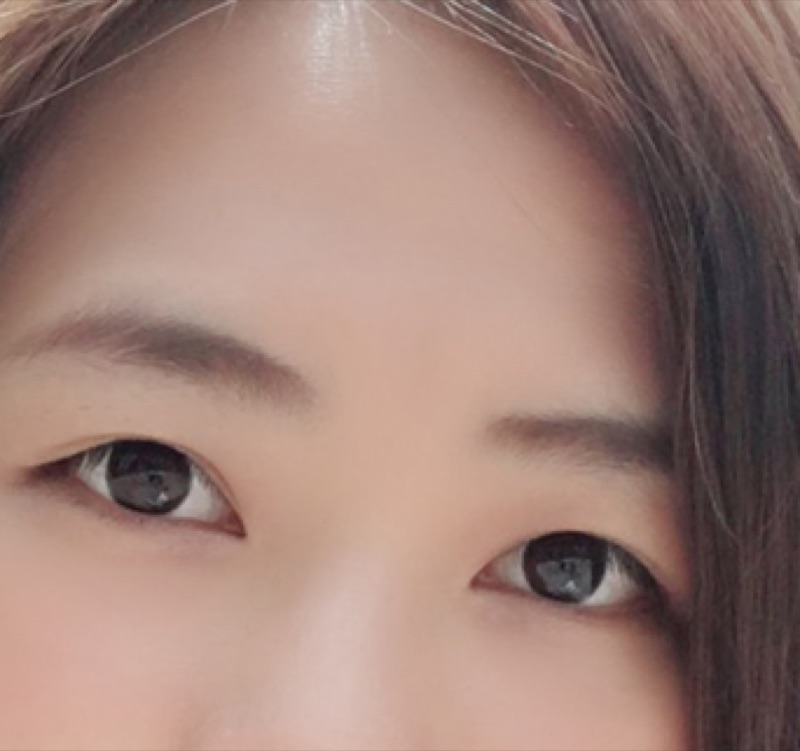 雙眼皮成形術案例紀錄