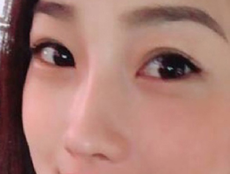 晶亮瓷注射塑形案例紀錄