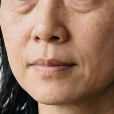 眼袋手術